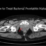 How to Cure Bacterial Prostatitis Naturally at Home