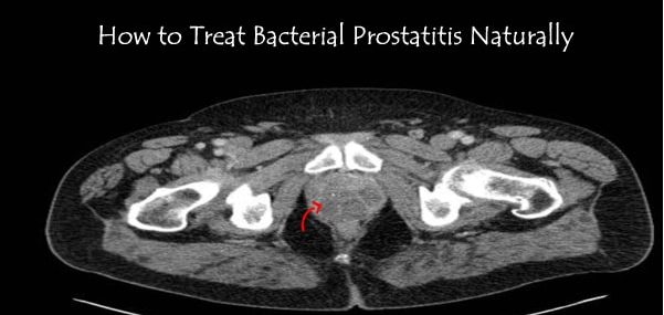 How to Cure Bacterial Prostatitis Naturally at Home