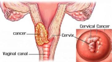 what is cervical cancer causes symtomps and treatment
