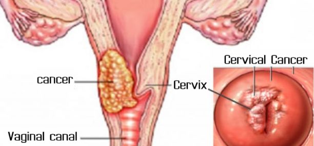 what is cervical cancer causes symtomps and treatment