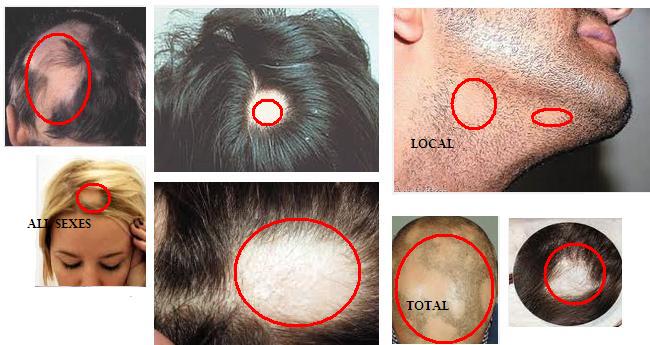 Alopecia disease