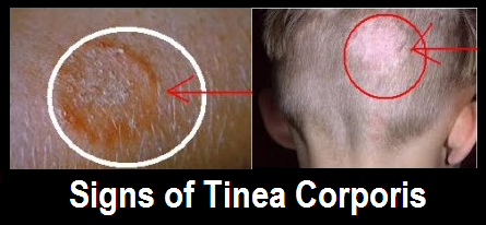 Tinea Corporis Symptoms Diagnosis and Treatment