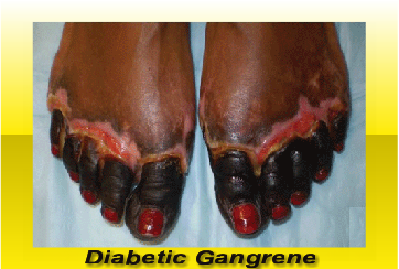 Diabetic gangrene