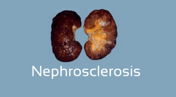what is nephrosclerosis