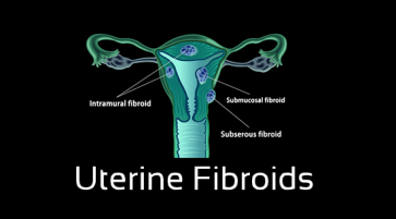 What are the different types of uterine fibroids
