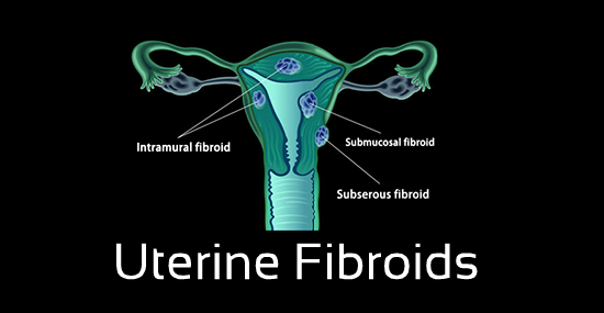 What are the different types of uterine fibroids