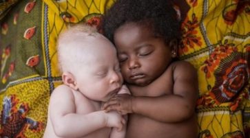 All about albinism