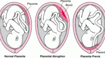 Orthodox treatment for Abruptio placenta