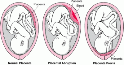 Orthodox treatment for Abruptio placenta
