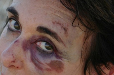 Orthodox treatment for bruises