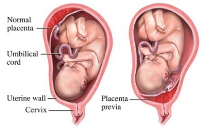 Orthodox treatment for placenta pervia