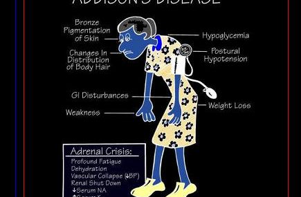All About Addisons Disease