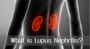 What is Lupus Nephritis