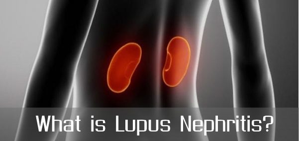 What is Lupus Nephritis