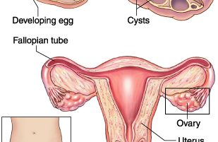 Polycystic ovarian disease