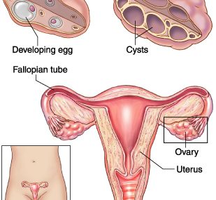 Polycystic ovarian disease