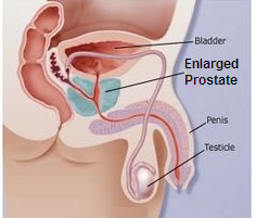 Prostate Treatment Tips