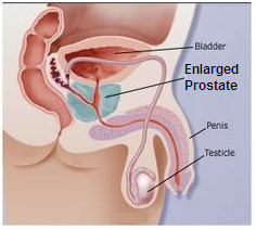 Prostate Treatment Tips