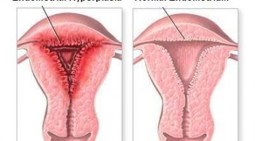 Recurrent Endometrial Hyperplasia