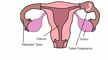 tubal pregnancy