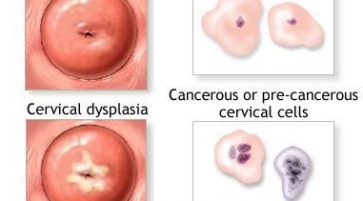 Cervical Dysplasia