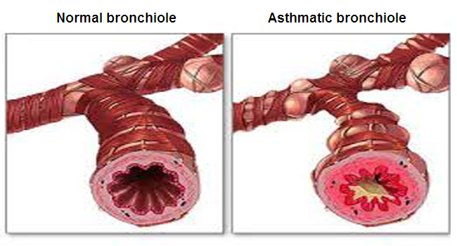 Orthodox treatment for Asthma