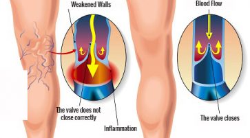 A cure for sciatica, varicosis and phlebitis in the legs
