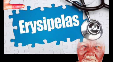 Erysipelas Types Epidemiology Clinic and treatment