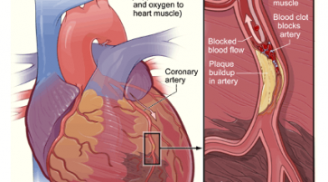 Myocardial Infarction volume and management using Cardiac Biomarkers