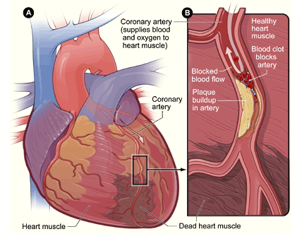 Myocardial Infarction volume and management using Cardiac Biomarkers