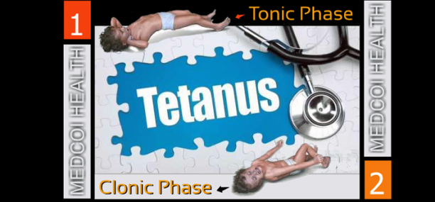 Tetanus Epidemiology clinic and treatment