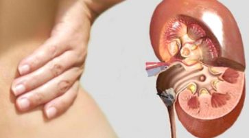 Natural Treatment for kidney stones and sand - to bring out the sand from the kidneys
