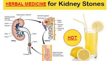 Natural Treatment to bring out kidney or liver calculi