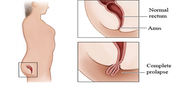 Natural Treatment for rectal prolapse especially in young children