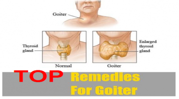 Natural Treatment for thyroid gland disorders, thyroiditis and goiter