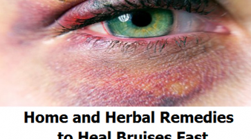 Natural Treatment to heal a bruise and alleviate cyanosis ache and convulsions after trauma or repast