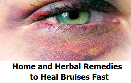Natural Treatment to heal a bruise and alleviate cyanosis ache and convulsions after trauma or repast