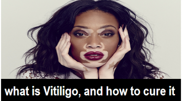 All you need to know about Vitiligo