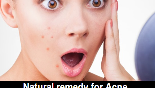 Natural remedy for acne, pimples, whiteheads and blackheads