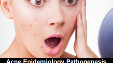 Acne Epidemiology Pathogenesis and Classification