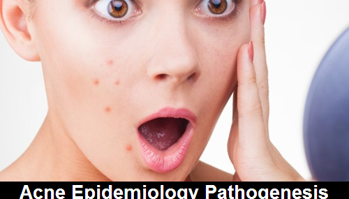 Acne Epidemiology Pathogenesis and Classification