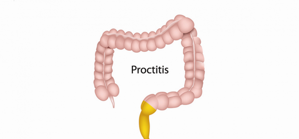 Proctitis Types Symptoms Causes Diagnosis and Treatment