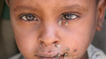 Trachoma Epidemiology Symptoms Diagnosis and Treatment