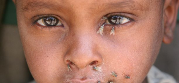 Trachoma Epidemiology Symptoms Diagnosis and Treatment
