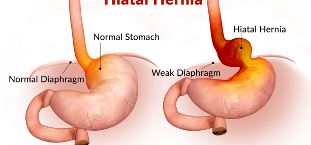 Hiatal Hernia Types Symptoms Diagnosis and Treatment