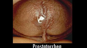 What is Prostatorrhea
