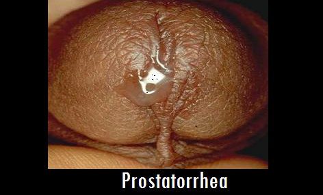 What is Prostatorrhea