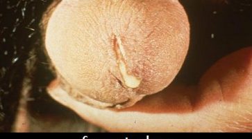 What is Spermatorrhoea