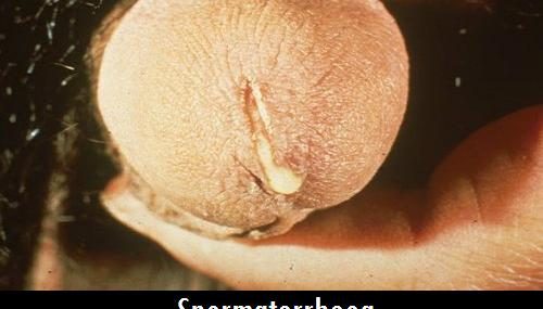 What is Spermatorrhoea