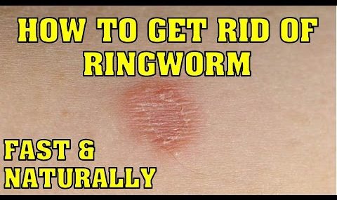 How to cure ringworm fast at home